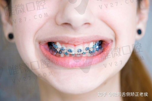 金属假牙和氧化锆假牙区别,假牙氧化锆的好还是全瓷的好(图1)